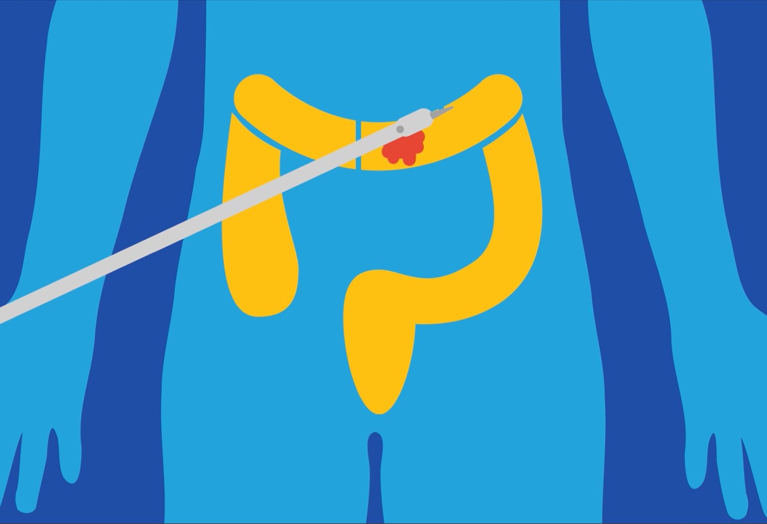 Illustration of the lower part of a body, highlighting the colon.